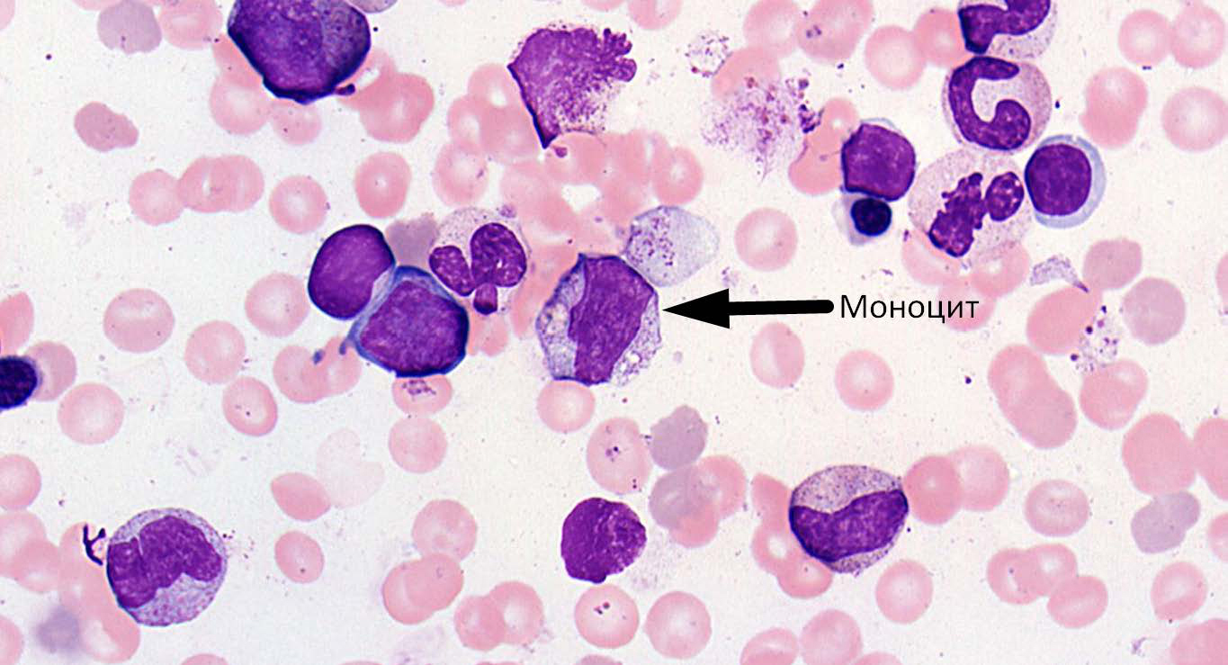 Моноциты в крови повышены: причины и что с этим делать